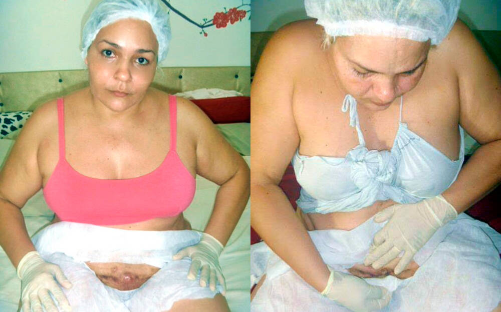 Maria Emília faz pulsão da secreção expelida pelo corte na barriga. Foto: Arquivo pessoal