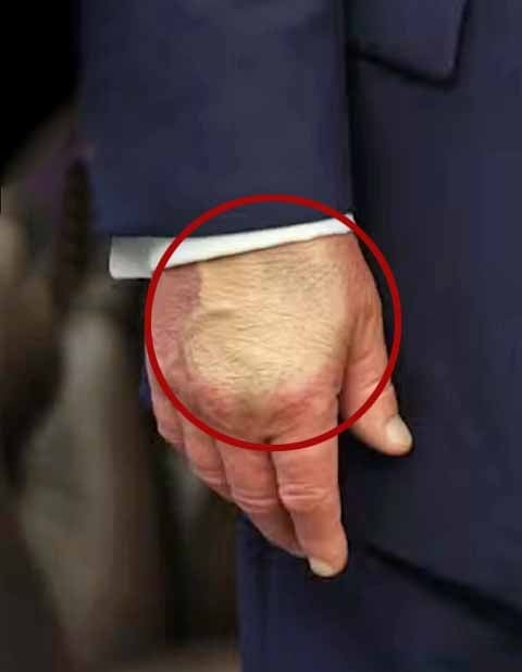 Segundo a porta-voz da Casa Branca, Karoline Leavitt, exames descartaram outras doenças sistêmicas em Donald Trump, como trombose venosa profunda, insuficiência cardíaca ou renal. 
 Reprodução: Flipar