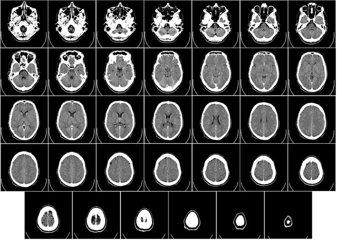 Além da avaliação dos sintomas, o diagnóstico requer exames complementares como tomografia e ressonância. Reprodução: Flipar