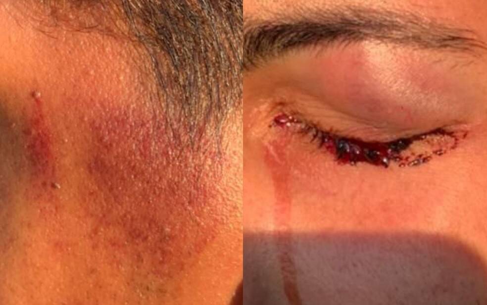Marido de avogado ficou com hematomas e ferimentos no rosto. Foto: REPRODUÇÃO/G1