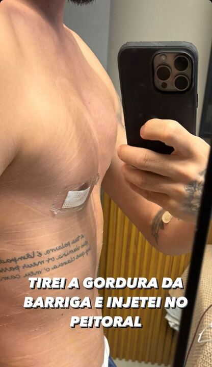 O influenciador postou fotos antes e depois de cirurgia Reprodução/Instagram - 01.04.2024