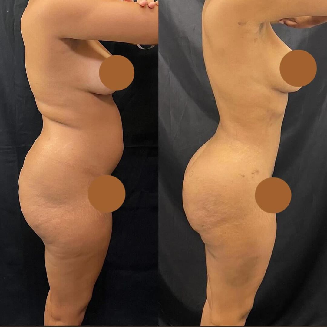 Thalyta Alves mostrou o antes e depois de sua lipoaspiração Reprodução/Instagram