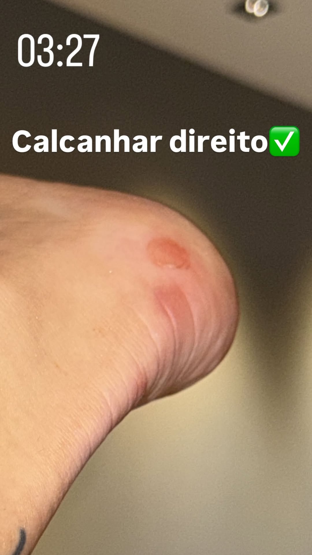 Virginia mostra calos nos pés após ensaio da Grande Rio.. Foto: Reprodução/Instagram/@virginia