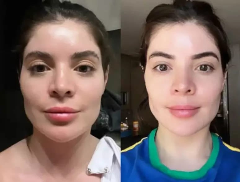 A influencer GKay fez harmonização em novembro de 2022, mas decidiu reduzir os efeitos do procedimento em fevereiro de 2023, para atenuar as alterações. E postou a comparação nas redes sociais. . Reprodução: Flipar