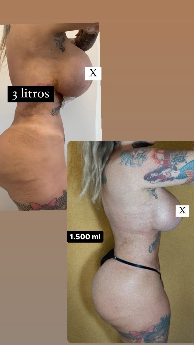 Sabrina Boing Boing mostra antes e depois de redução da protese de silicone Reprodução/Instagram