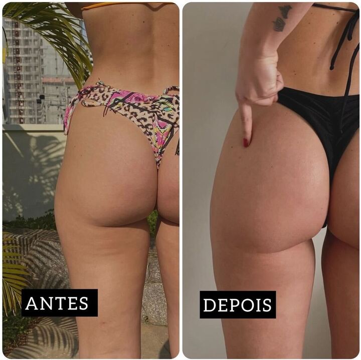 Antes e depois do culote de Jéssica Mueller após lipo Reprodução: Instagram