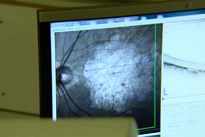 Embora ainda não exista cura, há formas de retardar sua progressão e, em alguns casos - especialmente na DMRI úmida - preservar parte da visão com tratamentos como injeções intraoculares, laser ou terapias medicamentosas específicas. 
 Reprodução: Flipar