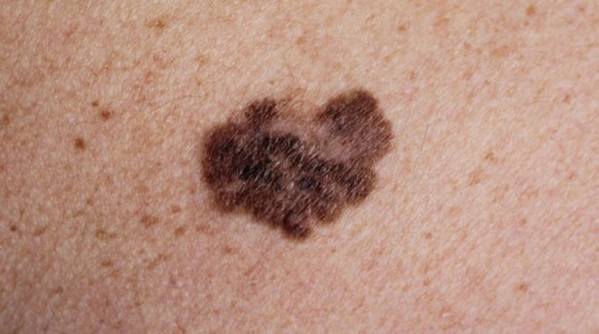 O tratamento é feito com cirurgia, remédios ou quimioterapia, dependendo do caso. A recuperação dura meses ou anos. Um melanoma pode aparecer em qualquer parte do corpo, em forma de pinta ou mancha. Se você perceber um sinal que era inexistente, procure o dermatologista. Reprodução: Flipar