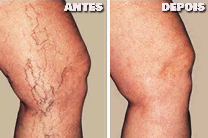 Essas práticas auxiliam na melhora da circulação sanguínea e aliviam os sintomas. 
 Reprodução: Flipar