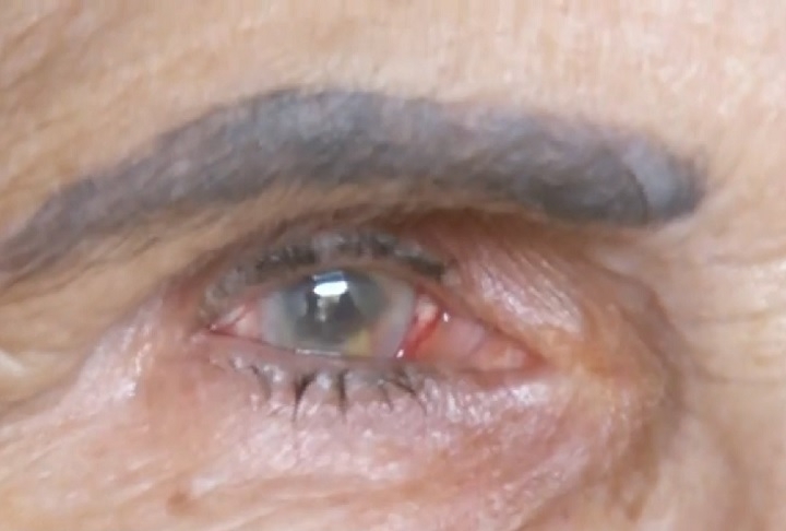 Com o tempo, essa turvação pode piorar, afetando atividades do dia a dia, como ler ou dirigir. O principal fator de risco para o desenvolvimento da catarata é o envelhecimento, mas há outras causas que podem acelerar o seu aparecimento. Reprodução: Flipar