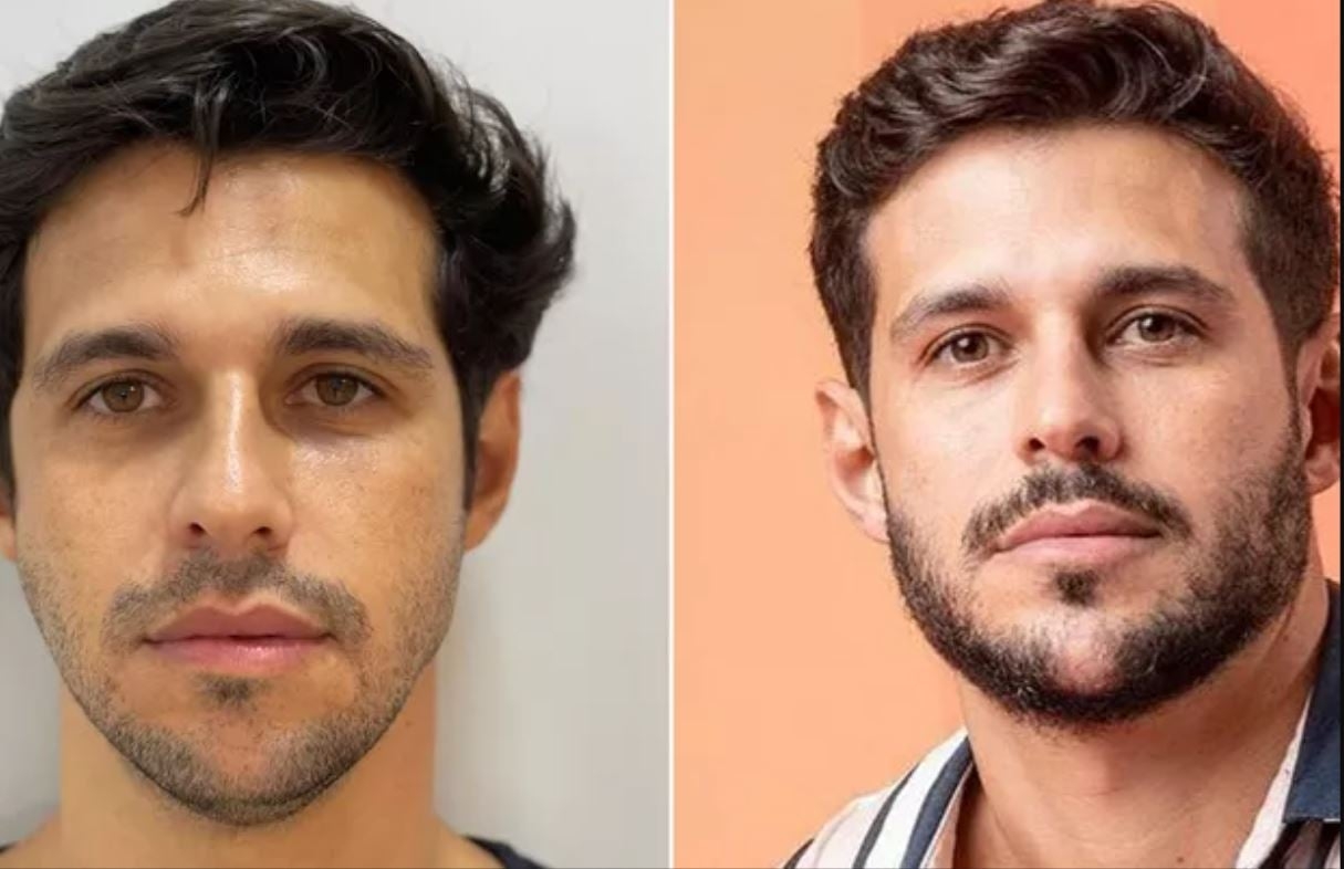 O ex-BBB Rodrigo Mussi passou pelo procedimento antes de entrar para o Big Brother. Ele fez preenchimentos com ácido hialurônico, principalmente para ganhar projeção do queixo. Reprodução: Flipar
