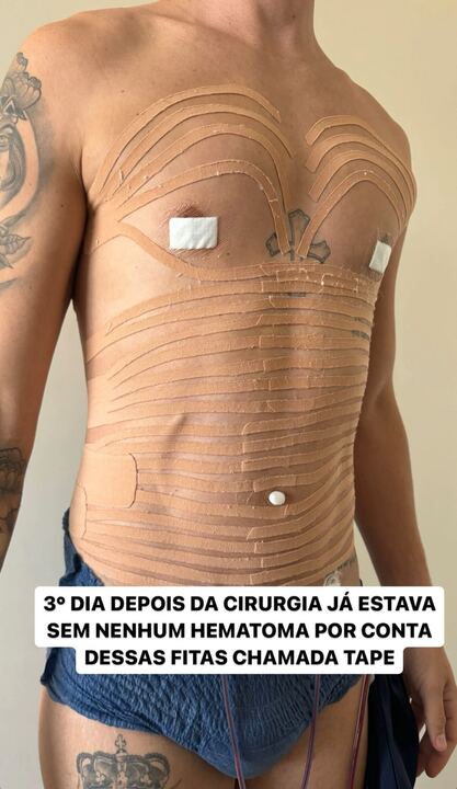 O influenciador postou fotos antes e depois de cirurgia Reprodução/Instagram - 01.04.2024