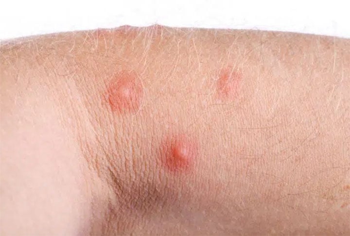 Após a picada da formiga, a pessoa têm queimação e coceira. Dependendo do número de picadas, se a pessoa for alérgica, os efeitos podem ser mais complexos, ocasionando coceira em todo o corpo, inchaço, necrose, dificuldade para respirar, coma e até mesmo morte Reprodução: Flipar