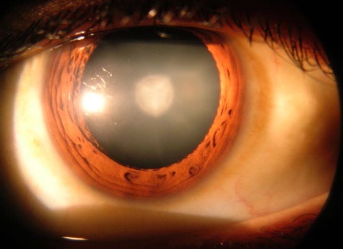 A catarata é uma doença ocular caracterizada pela opacidade do cristalino, a lente natural do olho, o que resulta em visão turva e dificuldade para enxergar. Reprodução: Flipar