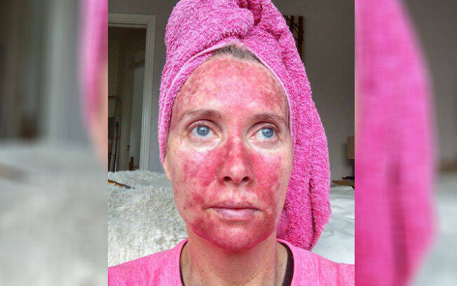 Margaret Murphy compartilhou todo o seu tratamento contra lesões pré-cancerígenas para alertar sobre os males de se tomar sol sem proteção. Foto: Facebook/ Mag's Murphys Journey/ Reprodução