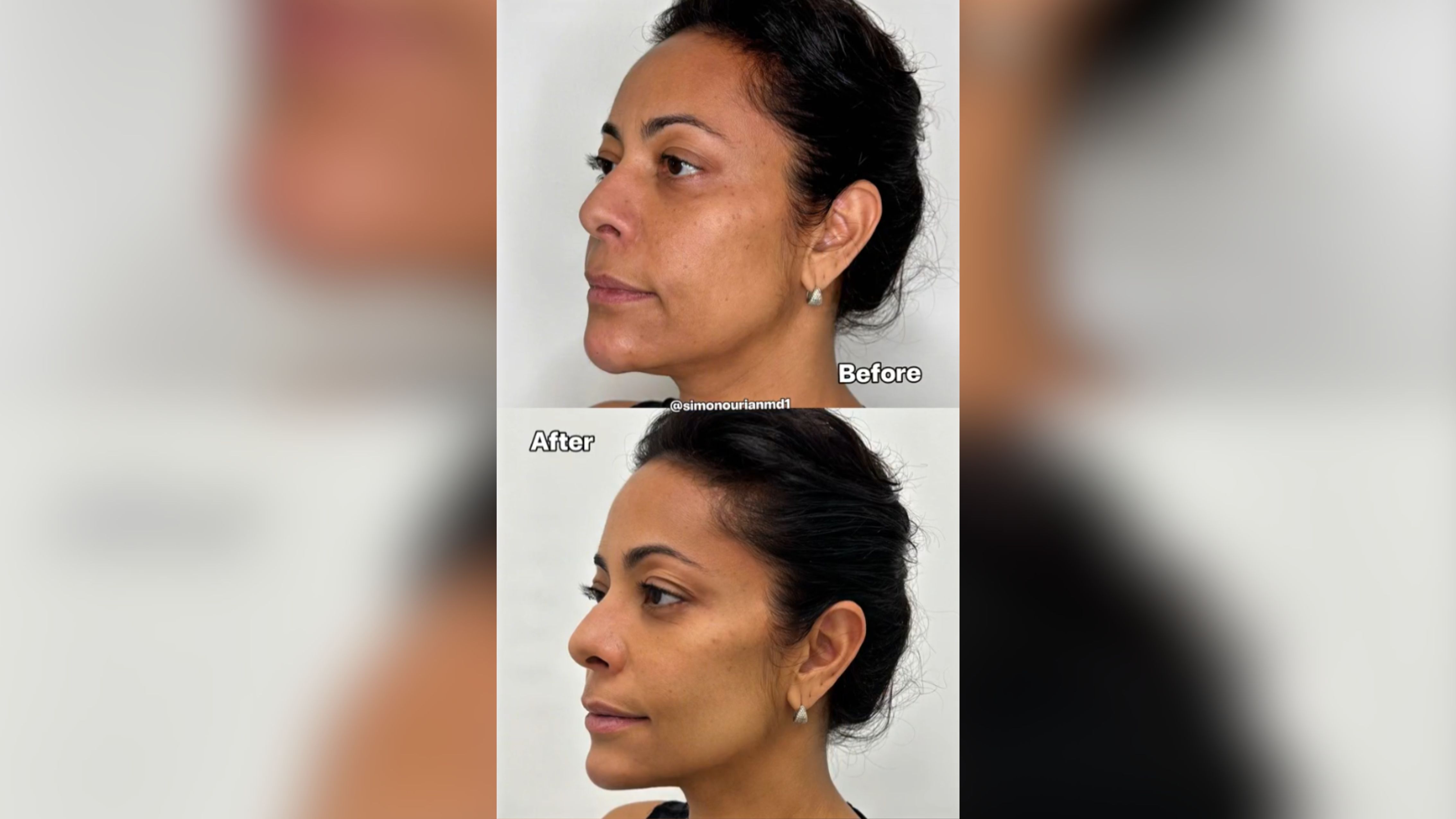 Antes e depois de Samantha Schmütz. Foto: X/@simonourianmd