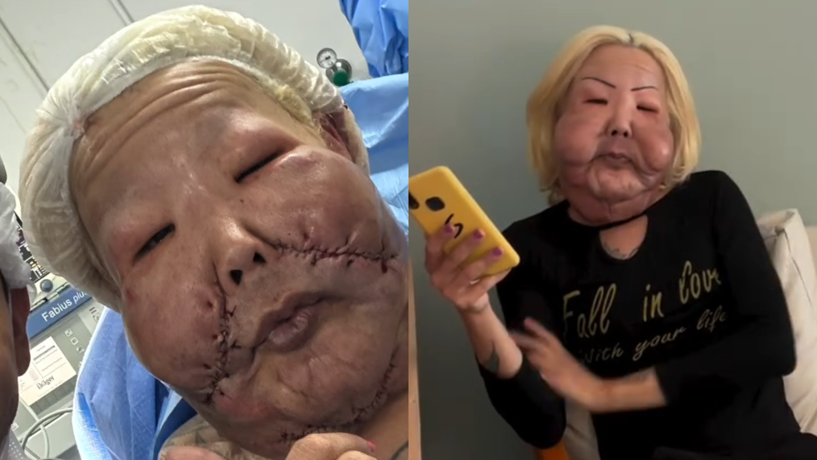 Médico posta antes e depois de Juju do Pix. Foto: Reprodução/ Instagram @drmarra