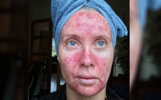 Margaret Murphy compartilhou todo o seu tratamento contra lesões pré-cancerígenas para alertar sobre os males de se tomar sol sem proteção. Foto: Facebook/ Mag's Murphys Journey/ Reprodução