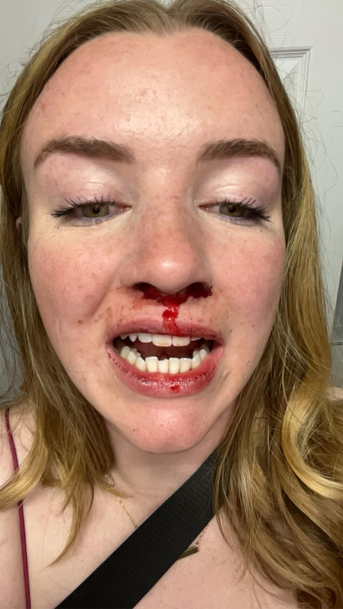 Tori sofreu ferimentos na face após agressão causada por homofobia Reprodução/Redes Sociais/Emma MacLean 