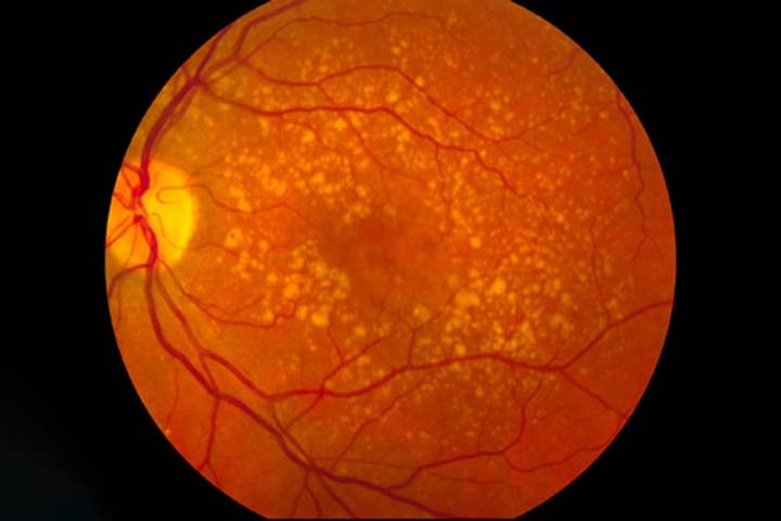 A degeneração macular é uma condição ocular caracterizada pelo desgaste gradual da mácula, a região central da retina responsável pela nitidez da visão. 
 Reprodução: Flipar