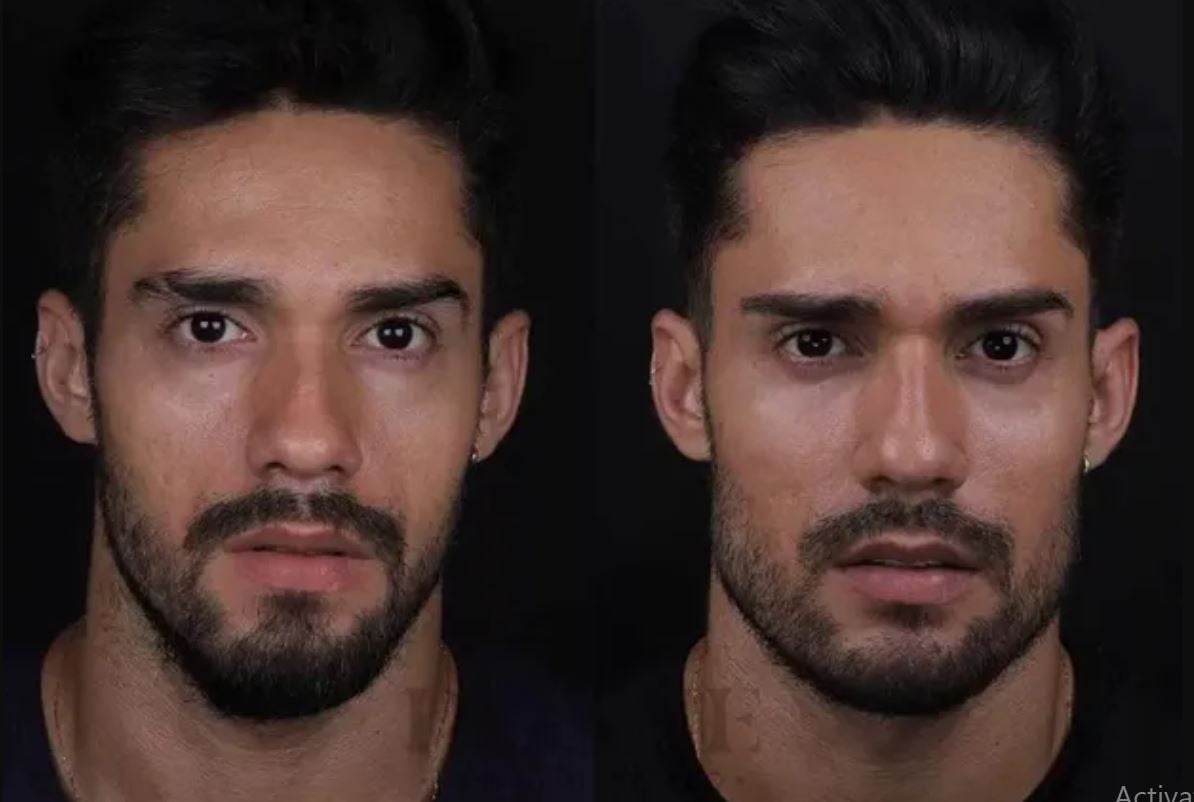 O modelo capixaba Bil Araújo fez harmonização facial antes de participar do BBB21. Ele ficou com o rosto mais volumoso, olheiras preenchidas e maxilar quadrado. Reprodução: Flipar