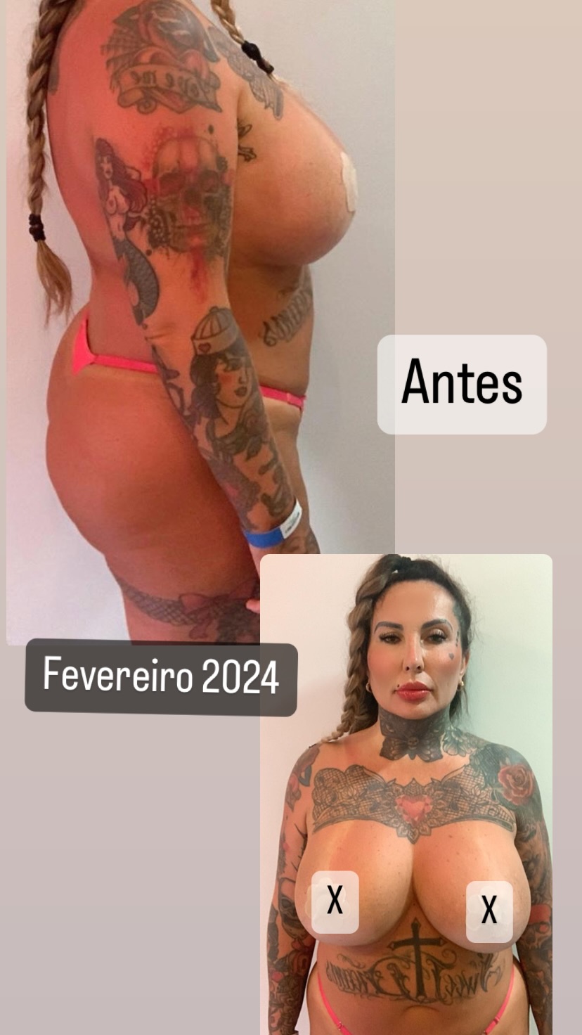 Sabrina Boing Boing mostra antes e depois de redução da protese de silicone Reprodução/Instagram