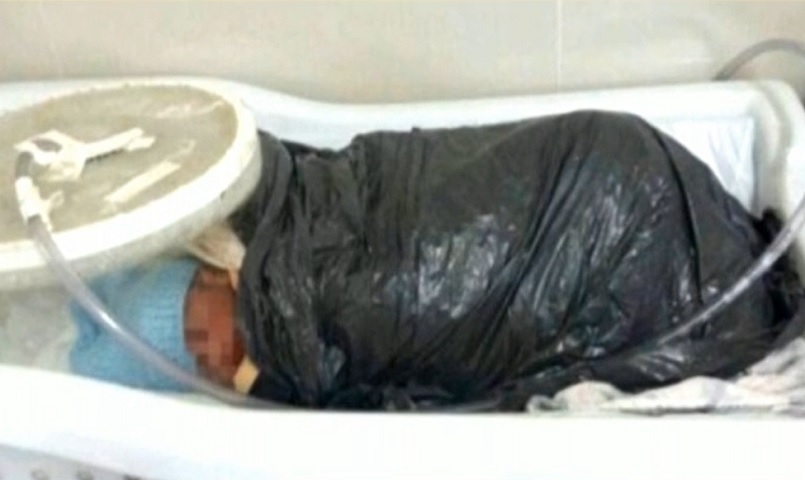 Saco de lixo: Em 2015, no interior do Maranhão, na falta de incubadora os médicos usaram sacos de lixo para manter dois bebês prematuros aquecidos. Reprodução: Flipar