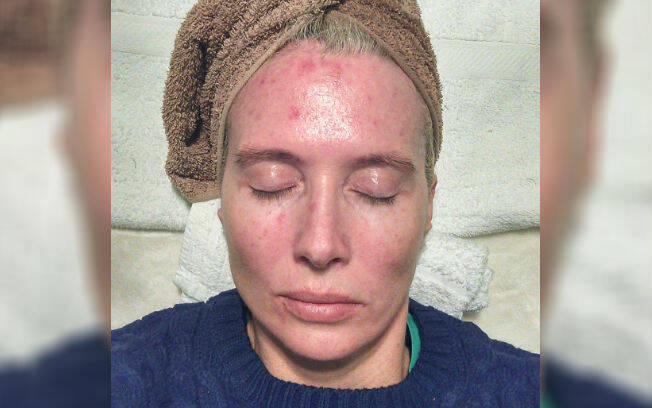 Margaret Murphy compartilhou todo o seu tratamento contra lesões pré-cancerígenas para alertar sobre os males de se tomar sol sem proteção. Foto: Facebook/ Mag's Murphys Journey/ Reprodução