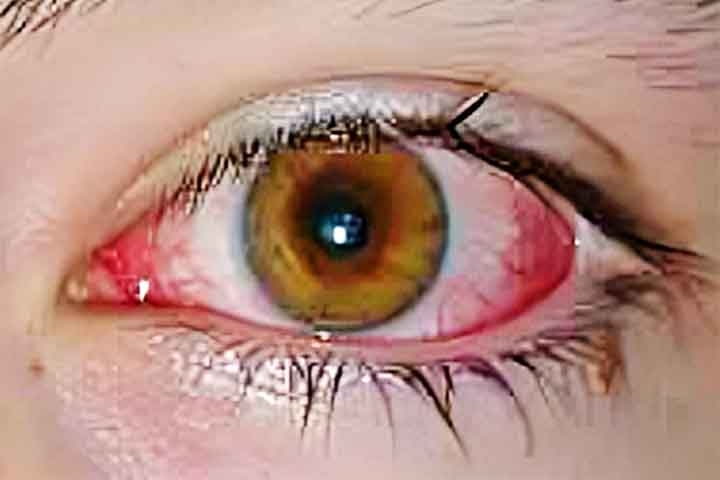 Já a conjuntivite é uma inflamação da membrana que reveste a parte anterior do olho e pode ser causada por infecções virais ou bacterianas, alergias ou substâncias químicas irritantes. Reprodução: Flipar