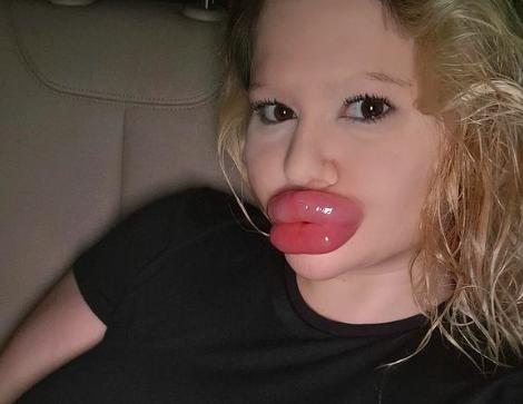 Influenciadora é famosa por ter os maiores lábios do mundo . Foto: Reprodução/Instagram