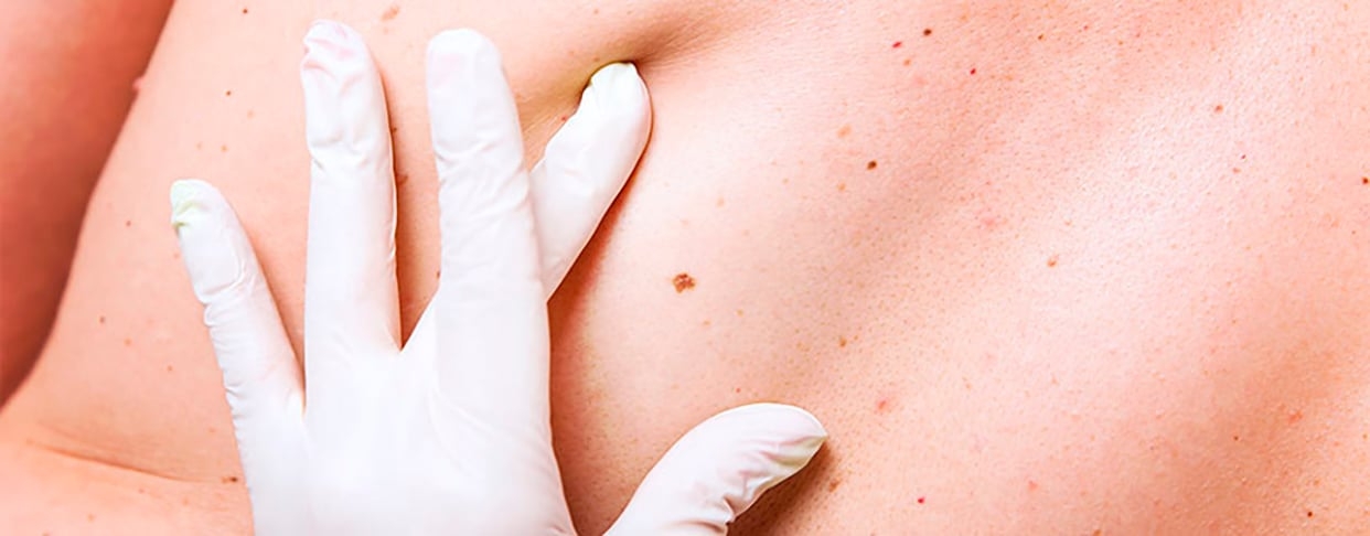 Em geral, a doença ataca mais as pessoas acima de 40 anos. A incidência tem níveis semelhantes entre os sexos, mas os homens morrem mais.  Existem quatro tipos de melanomas, que são os mais raros, mas também os mais agressivos. O mais comum é o extensivo superficial. É o mais temido pelos jovens. Reprodução: Flipar