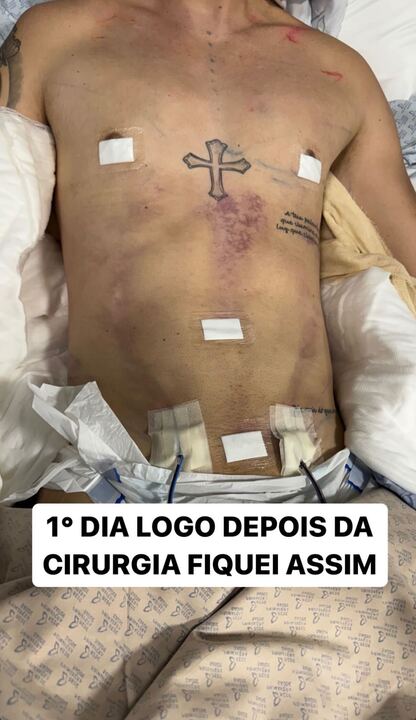 O influenciador postou fotos antes e depois de cirurgia Reprodução/Instagram - 01.04.2024