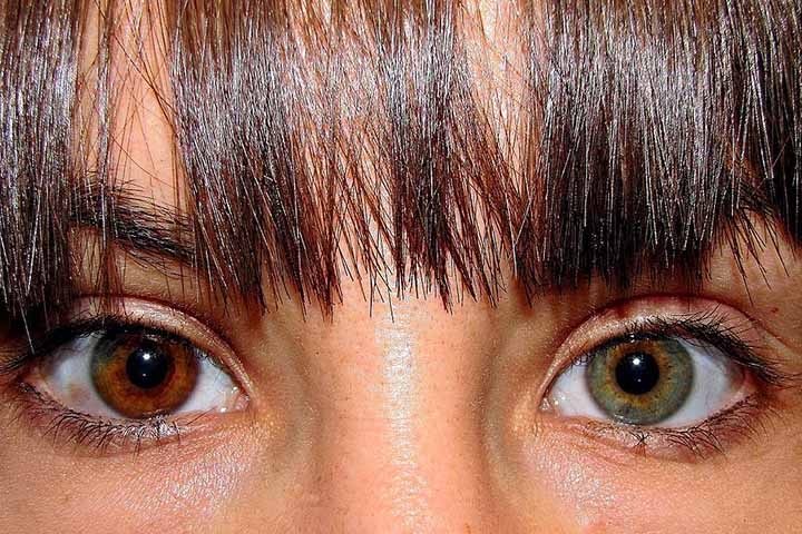 Você já ouviu falar em heterocromia? Trata-se de uma condição em que uma pessoa apresenta diferença de cor nas íris dos olhos.  Reprodução: Flipar