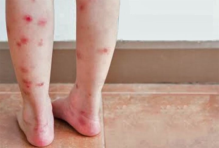 Quando a pessoa alérgica é picada por mosquitos pode ficar com manchas vermelhas que incomodam bastante. É preciso ter cuidado redobrado com crianças. Para quadros mais complexos, há tratamento com vacinas.  Reprodução: Flipar