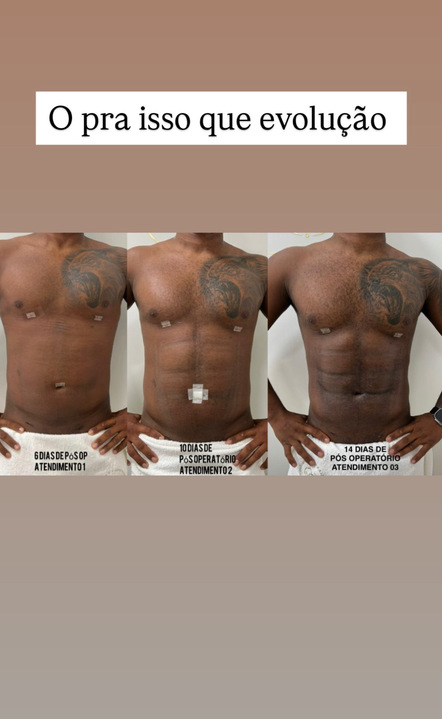 Corpo de Davi Brito após lipo HD. Foto: Reprodução: Instagram/@daviooficialll