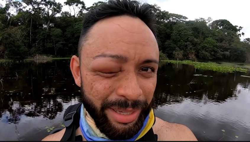 Em julho de 2023,, o produtor de vídeos de pescaria esportiva Felipe Paker foi atacado por vespas e ficou com o rosto desfigurado. Ele tentava pescar um pirarucu em águas do Pará quando foi surpreendido.  Reprodução: Flipar
