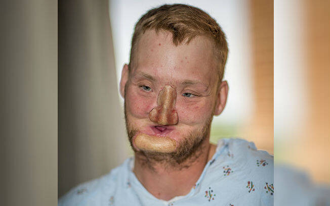 O americano Andy Sandness, hoje com 32 anos, terá a chance de voltar a ter uma vida normal e formar a própria família após o transplante. Foto: Mayo Clinic/ Divulgação