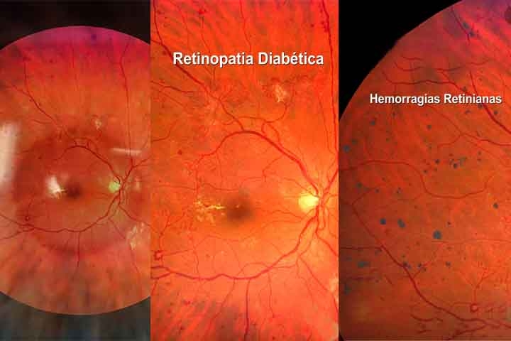 Outra doença ocular comum é a retinopatia diabética, que afeta a retina de pacientes com diabetes. O problema ocorre quando os níveis elevados de glicose no sangue danificam os vasos sanguíneos da retina, levando à perda progressiva da visão. Reprodução: Flipar