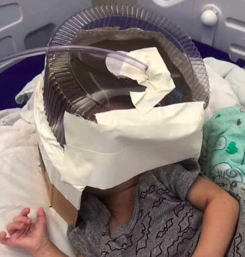 Embalagem de bolo: Em 2024, no Rio Grande do Norte, uma médica do precisou improvisar um respirador com uma embalagem de bolo para salvar a vida de um bebê que aguardava vaga na UTI. Reprodução: Flipar