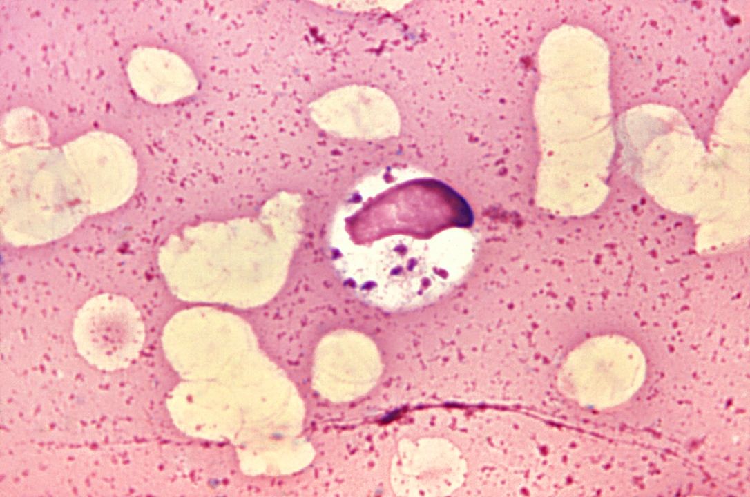 Leishmaniose - Causada pelo protozoário Leishmania, transmitido pelo mosquito-palha, com cães como reservatórios. Os sintomas incluem febre, fraqueza e feridas na pele Reprodução: Flipar