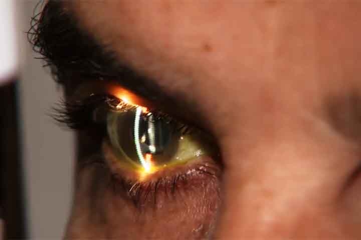A degeneração macular relacionada à idade (DMRI) é outra condição que merece atenção, pois afeta a mácula, área central da retina responsável pela visão detalhada. A DMRI pode levar à perda progressiva da visão central, dificultando atividades como leitura e reconhecimento de rostos. Reprodução: Flipar