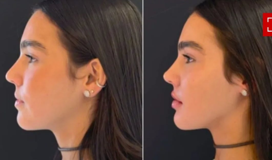 Em outubro de 2024, Duda Guerra, namorada de Benício Huck (filho de Luciano Huck e Angélica) mostrou o resultado da harmonização facial que rla fez porque se sentia incomodada com a “pontinha” de seu nariz. Reprodução: Flipar