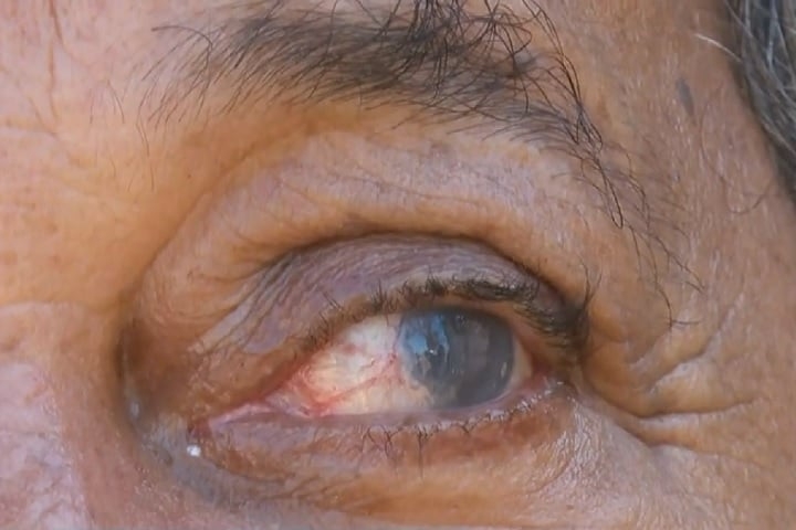Os pacientes também criticam a falta de apoio do AME e da Santa Casa de Franca. Segundo eles, medidas como fornecimento de colírios e inclusão na fila de transplante só ocorreram depois de muita insistência. Reprodução: Flipar