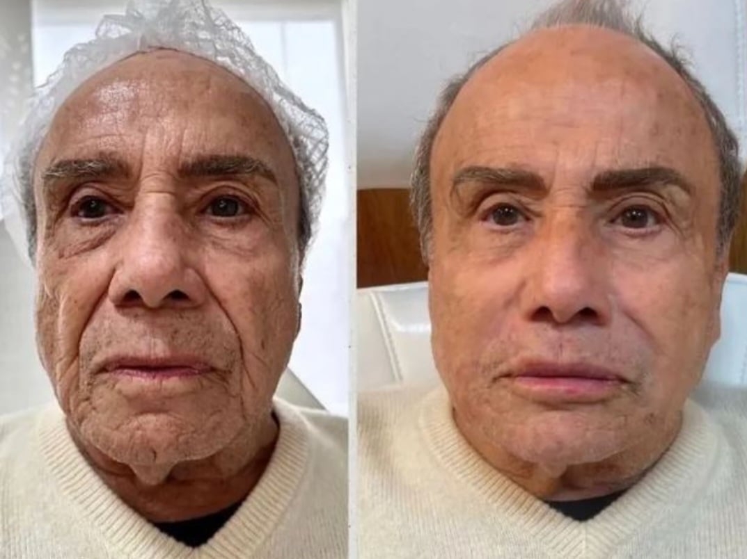 O ator Stenio Garcia fez harmonização em junho de 2023. Ele foi internado em julho e houve quem especulasse uma relação com o procedimento, mas isso foi negado.  Reprodução: Flipar