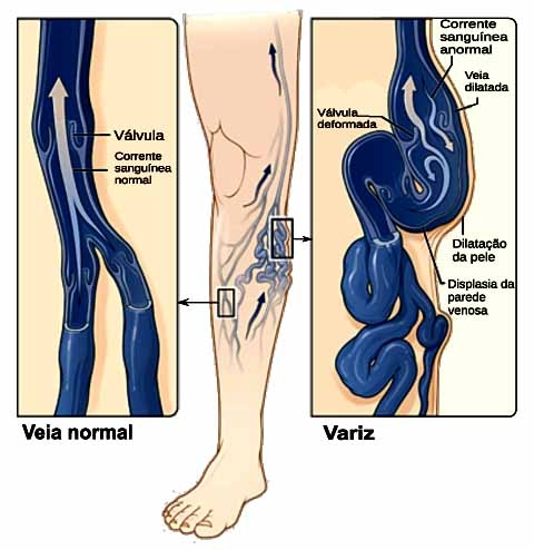 A insuficiência venosa crônica é uma condição em que as veias - principalmente as das pernas - perdem a capacidade de transportar o sangue de volta ao coração de forma eficiente. 
 Reprodução: Flipar