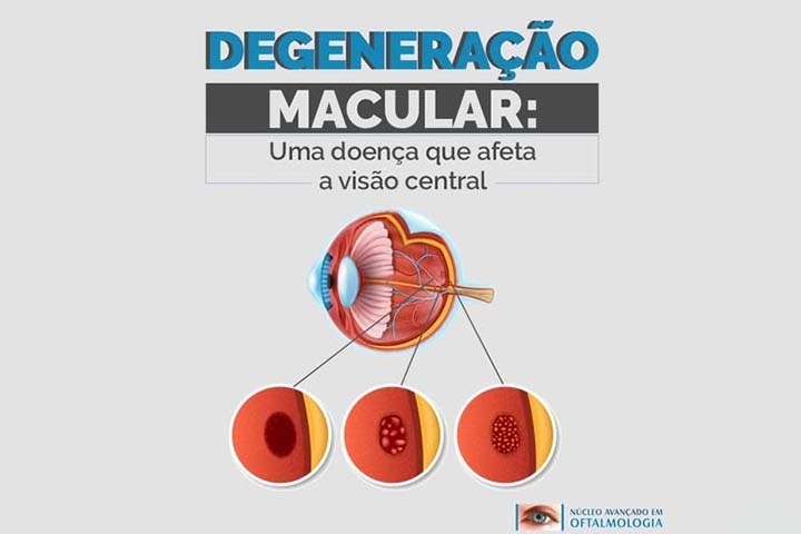 Existem dois tipos principais da doença: a degeneração macular seca e a úmida. A forma seca, mais comum, ocorre de maneira lenta e progressiva, decorrente do afinamento natural da mácula e do acúmulo de depósitos chamados drusas. 
 Reprodução: Flipar