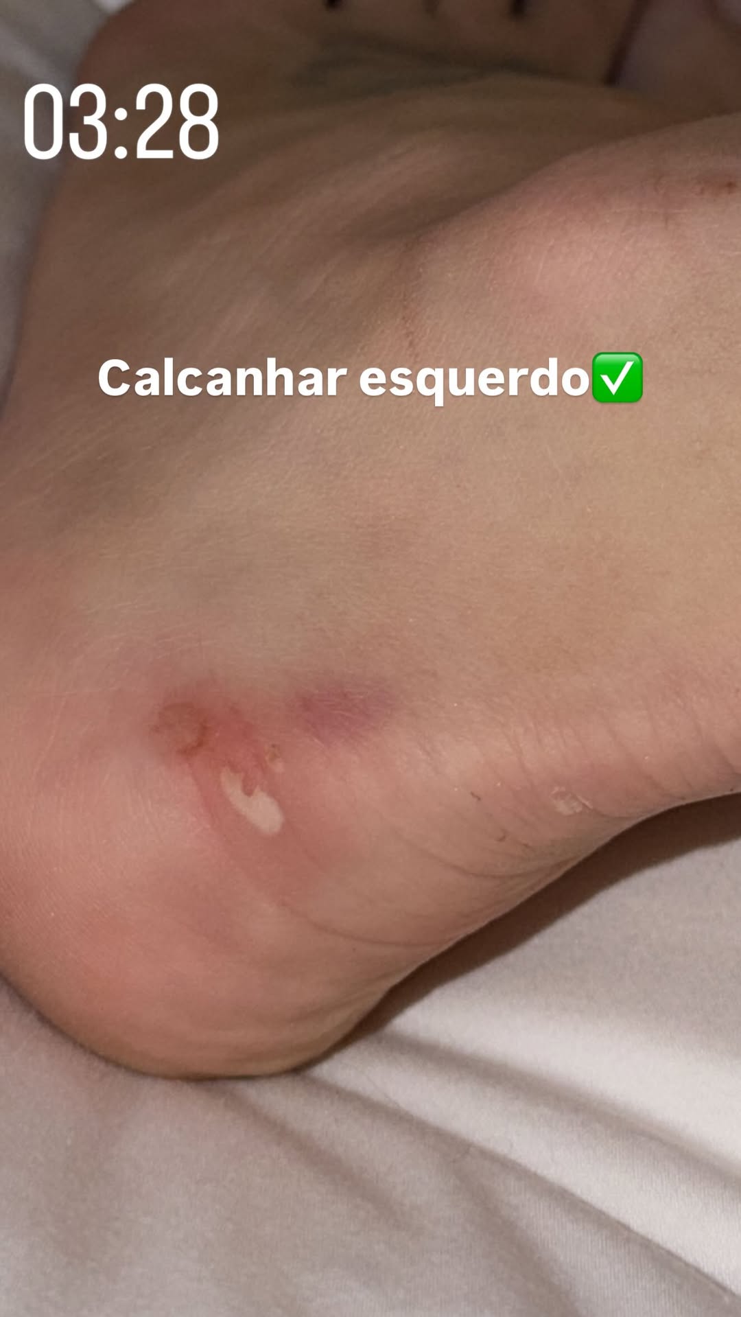 Virginia mostra calos nos pés após ensaio da Grande Rio.. Foto: Reprodução/Instagram/@virginia