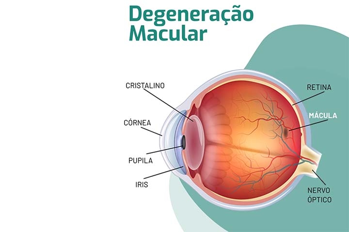 Já a forma úmida, menos frequente, é mais agressiva e resulta do crescimento anormal de vasos sanguíneos sob a retina, que podem vazar líquido ou sangue e causar perda visual mais rápida.
 Reprodução: Flipar