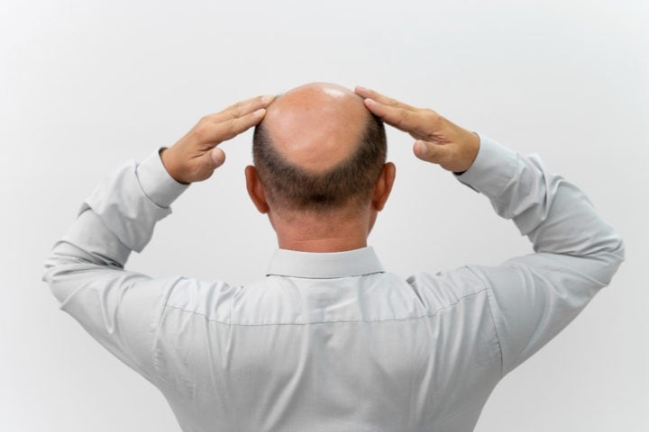 Hoje, sabe-se que o minoxidil melhora a circulação nos folículos capilares, fornecendo mais oxigênio e nutrientes, além de prolongar a fase de crescimento do cabelo (conhecida como anágena). Reprodução: Flipar