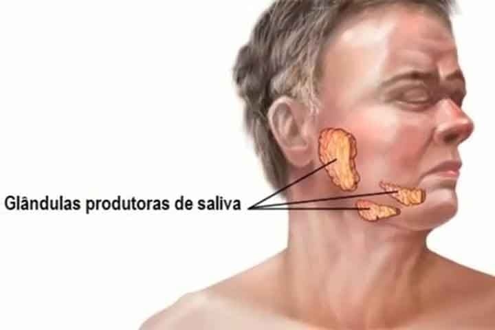 No caso do inchaço nas glândulas, é recomendável fazer compressas mornas na região para aliviar o desconforto. 
 Reprodução: Flipar